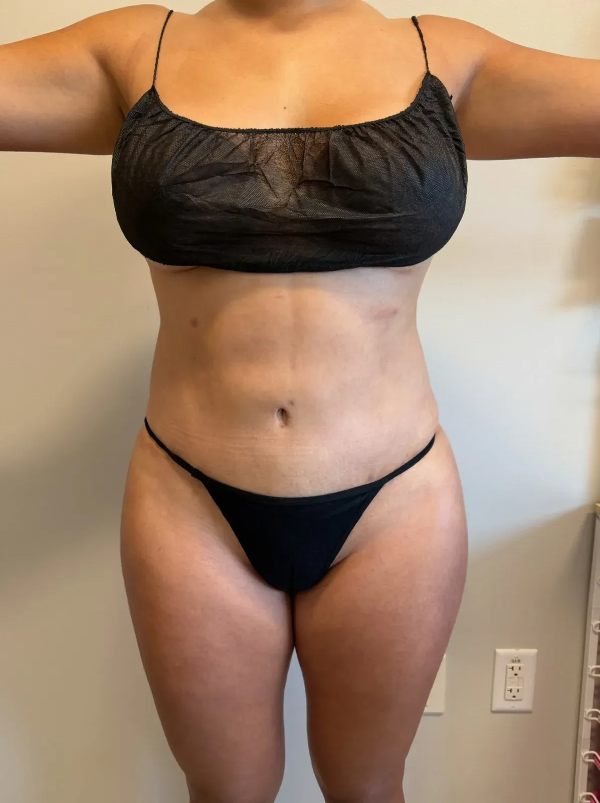 After liposuction and Renuvion, front view, case 1001