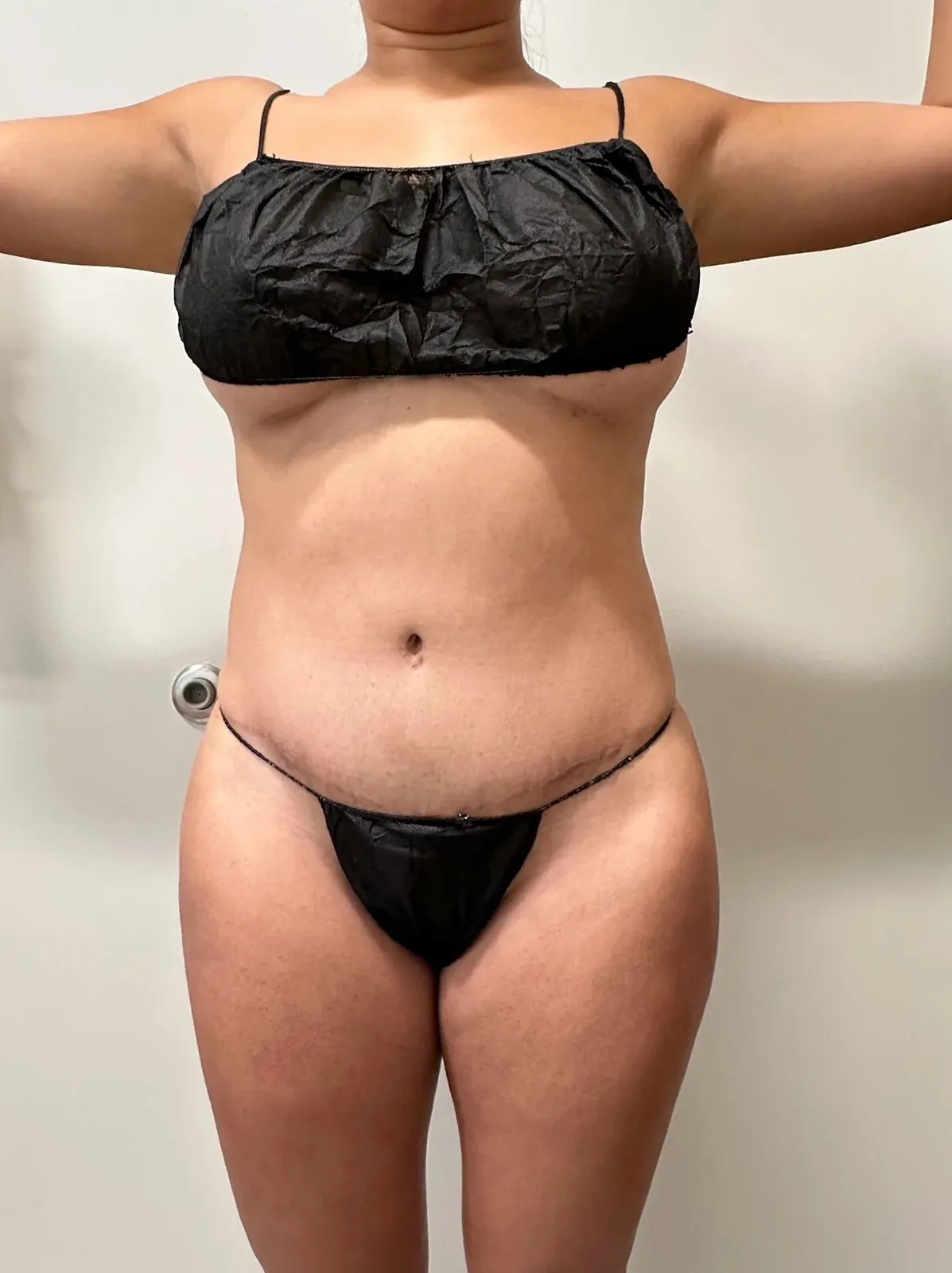 Before liposuction and Renuvion, front view, case 1001