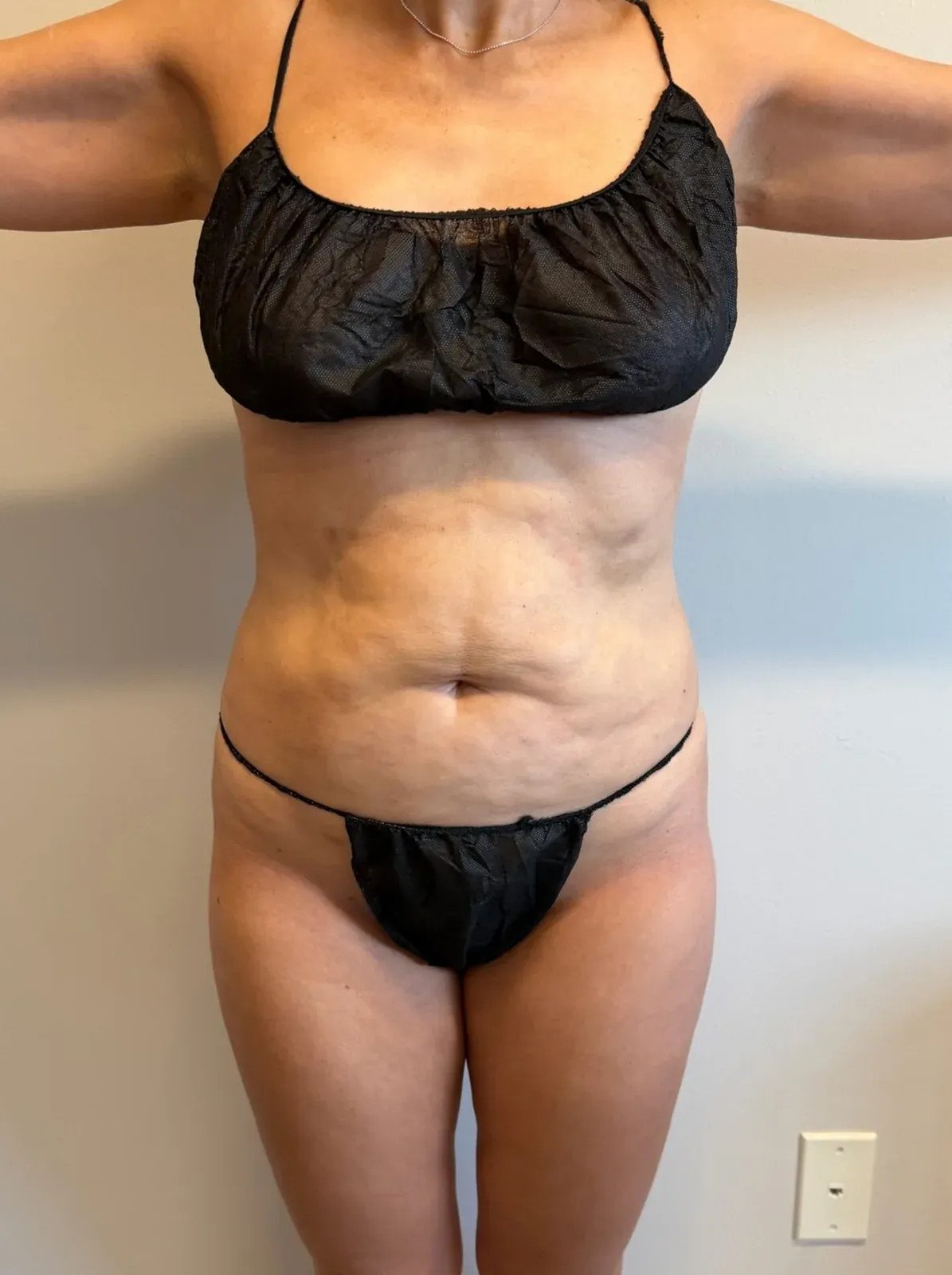 After liposuction and Renuvion, front view, case 1002