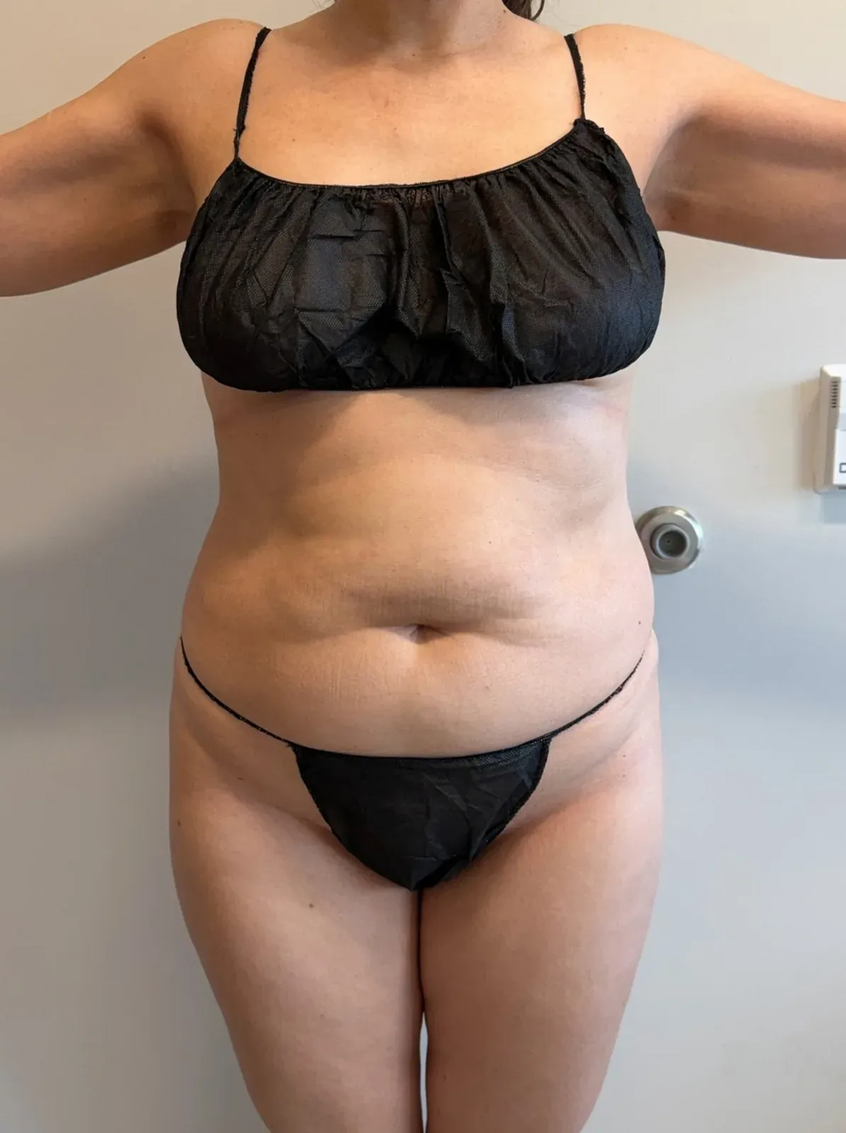 Before liposuction and Renuvion, front view, case 1002