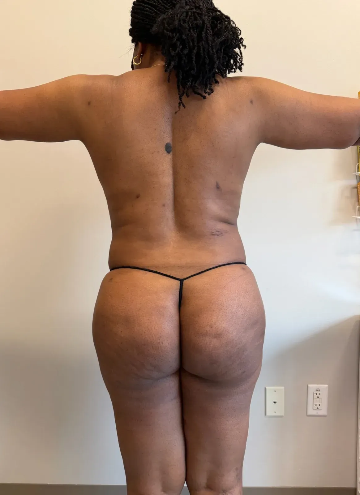 After liposuction and Renuvion, back view, case 1003
