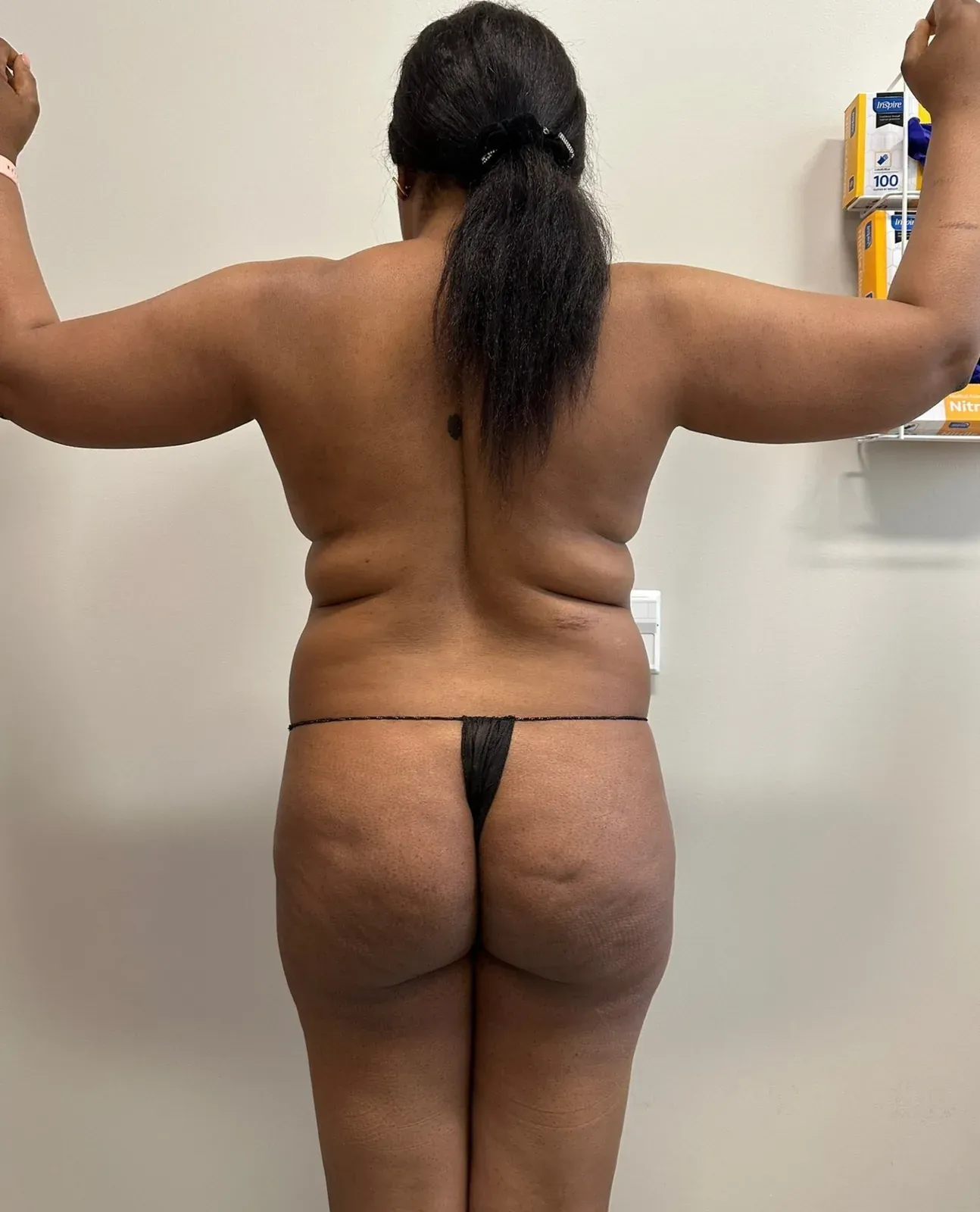 Before liposuction and Renuvion, back view, case 1003