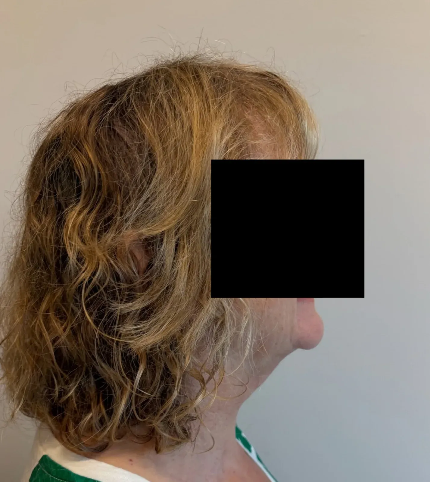 After chin and neck liposuction and Renuvion, side view, case 1004