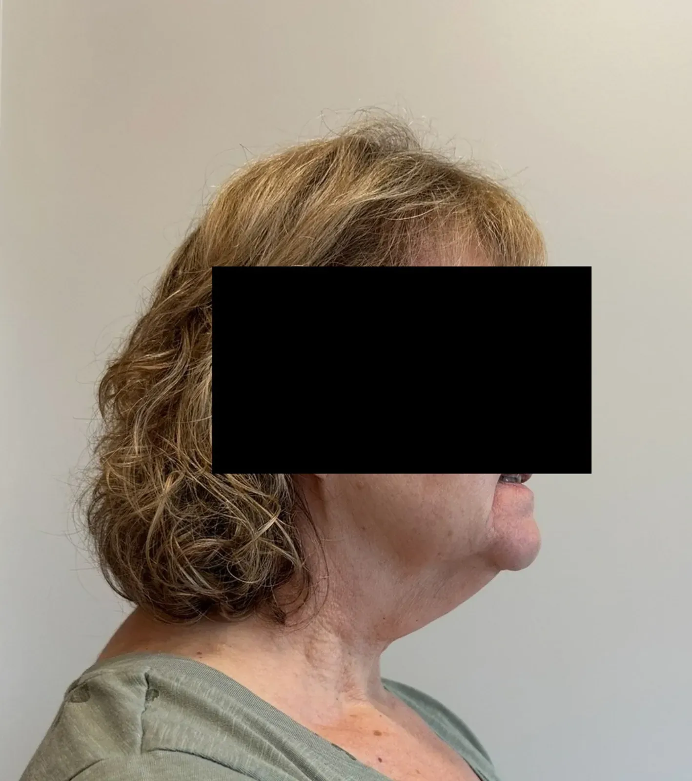 Before chin and neck liposuction and Renuvion, side view, case 1004