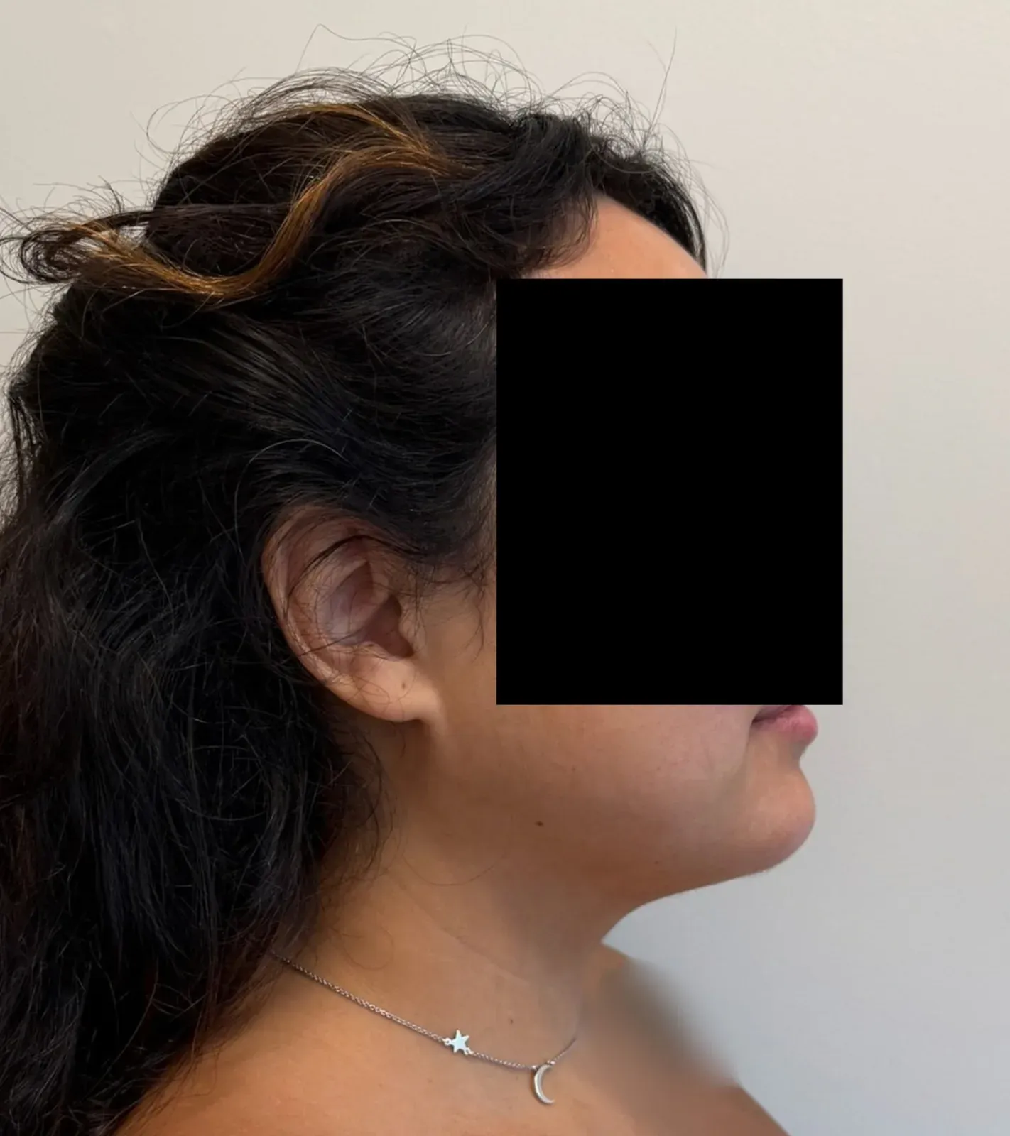 After chin and neck liposuction and Renuvion, side view, case 1005