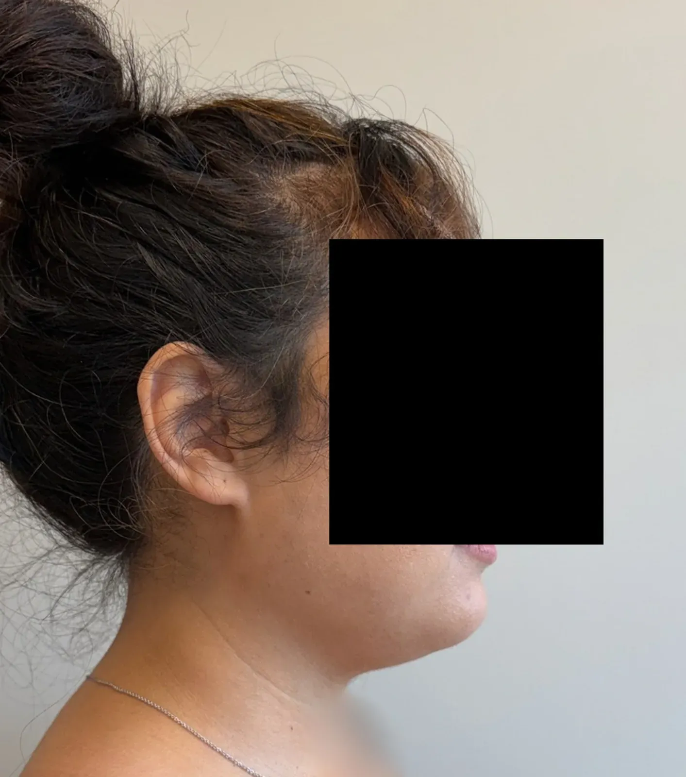 Before chin and neck liposuction and Renuvion, side view, case 1005