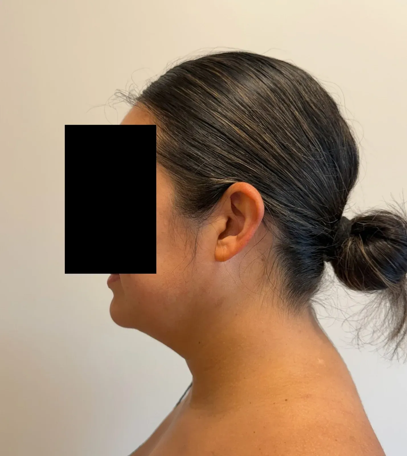 After chin and neck liposuction and Renuvion, side view, case 1008