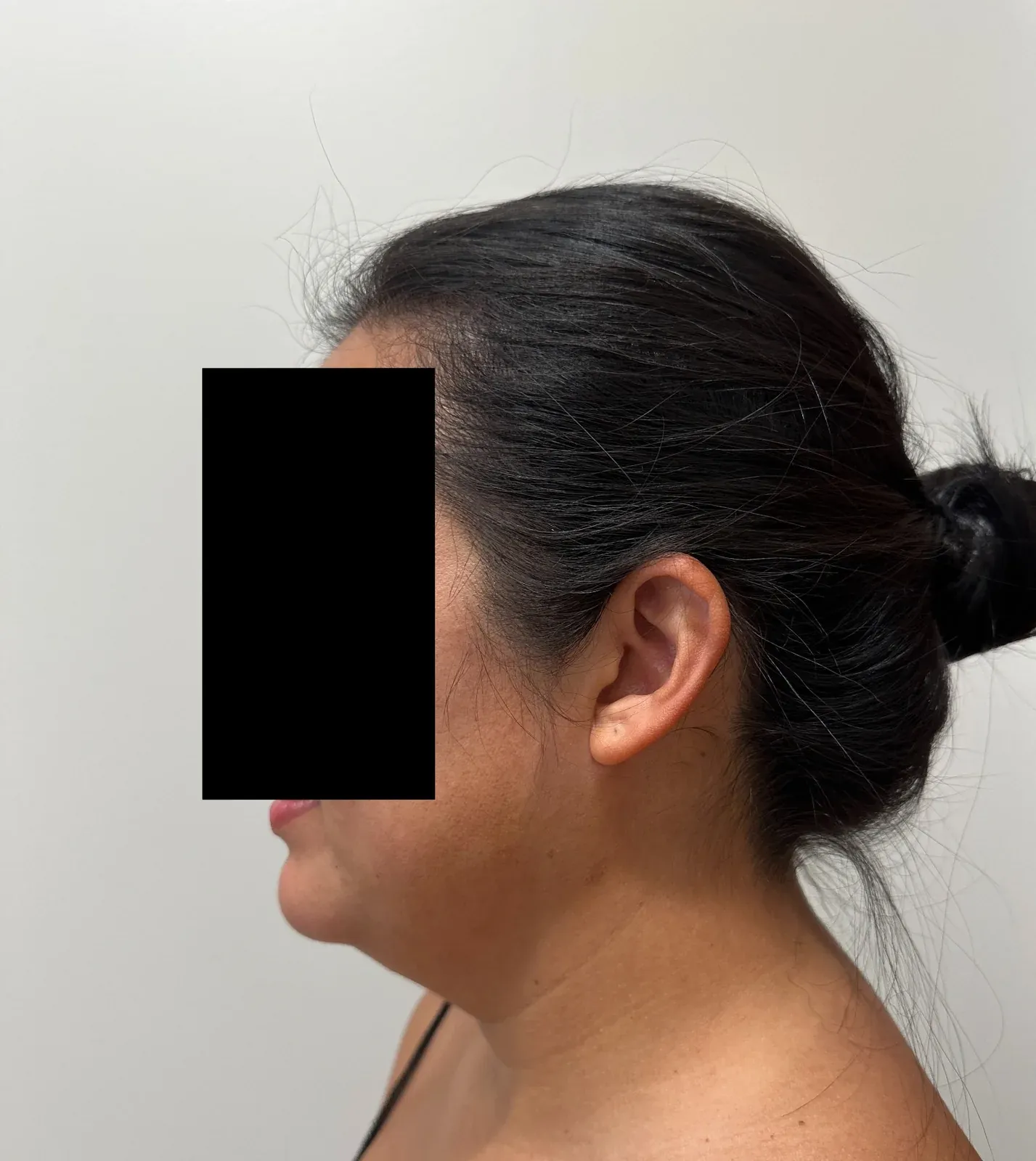 Before chin and neck liposuction and Renuvion, side view, case 1008