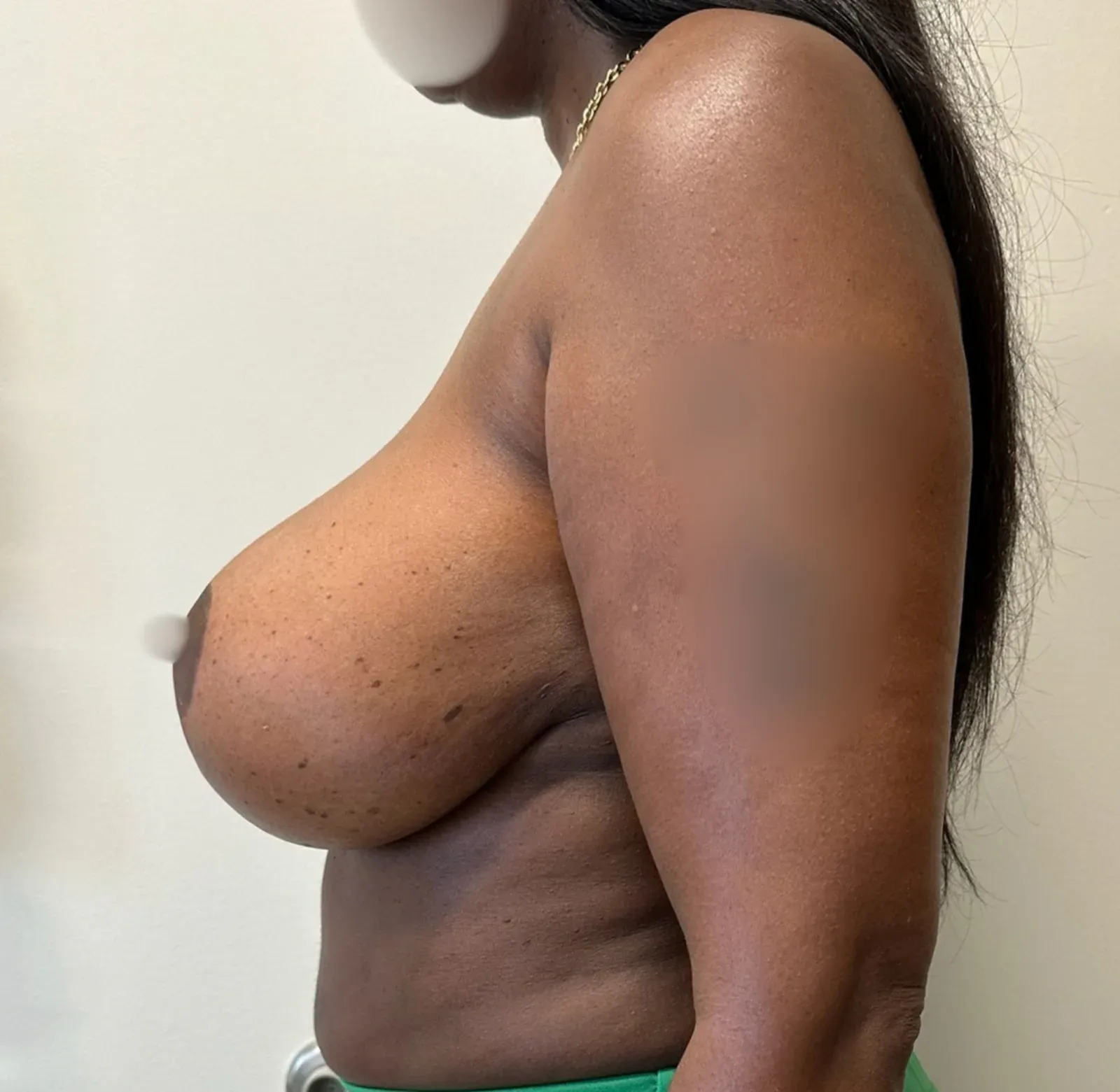 After breast lift, side view, case 1012