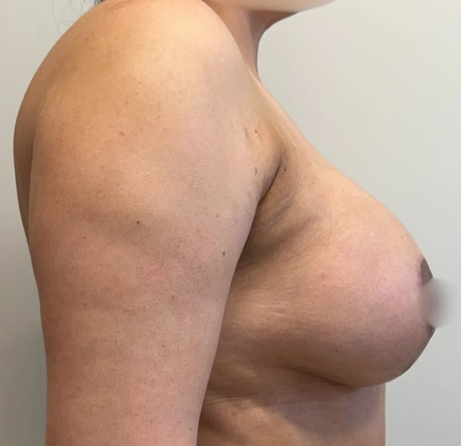 After breast lift with implants, side view, case 1013