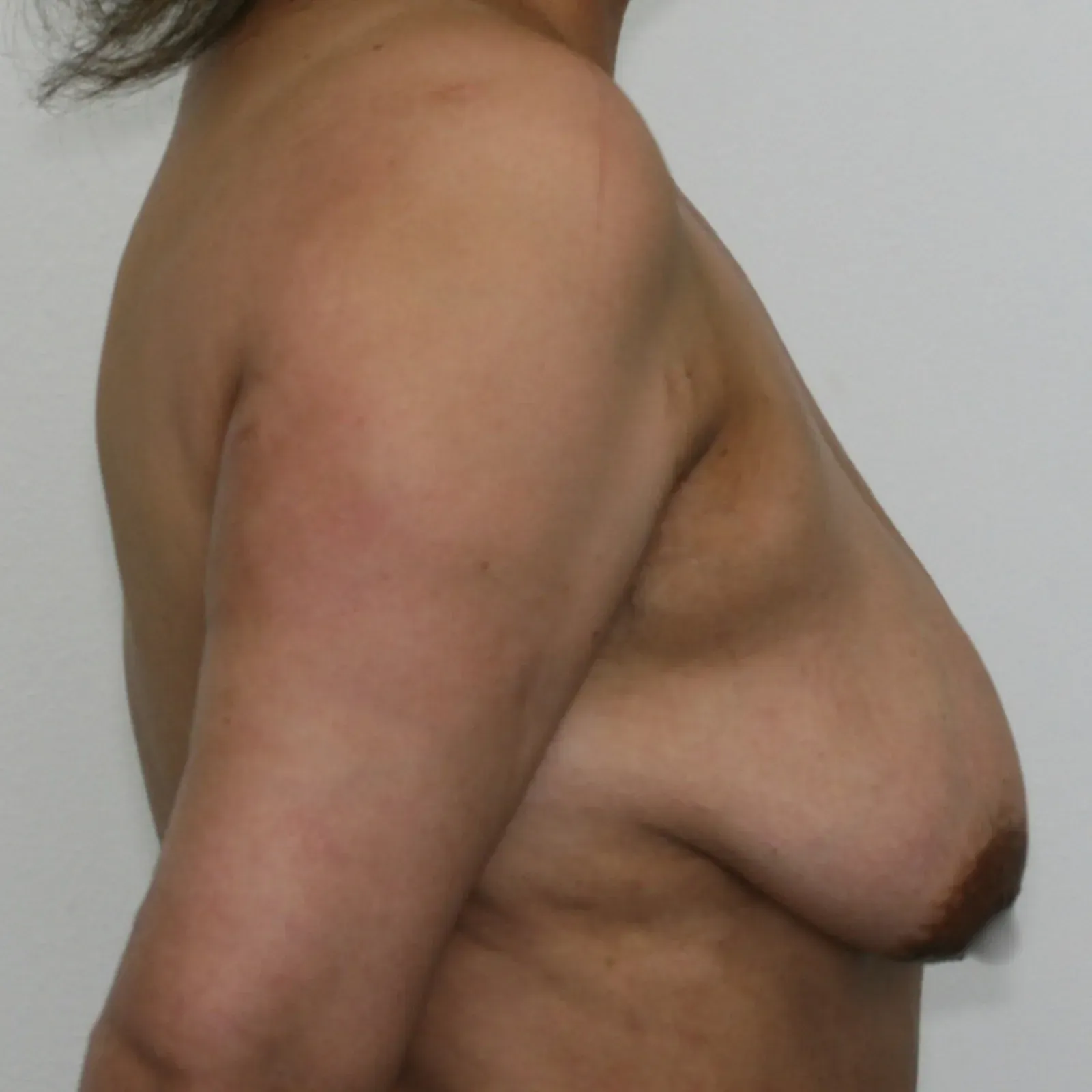 Before breast lift with implants, side view, case 1013