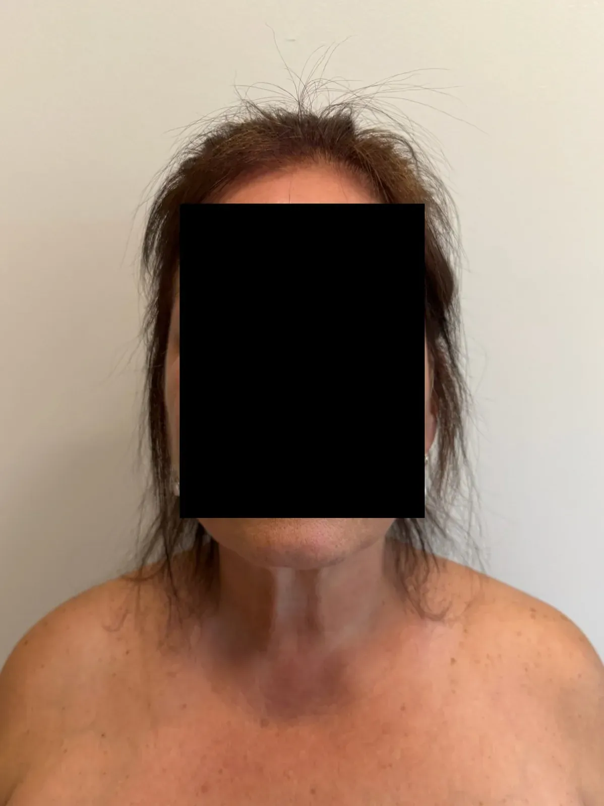 After chin and neck liposuction and Renuvion, front view, case 1015