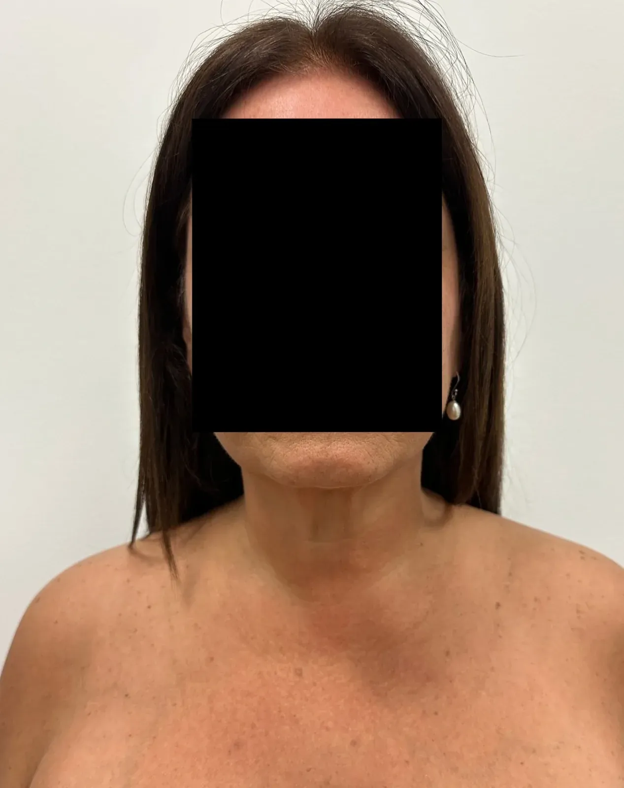 Before chin and neck liposuction and Renuvion, front view, case 1015