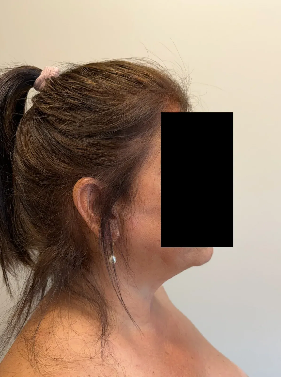 After chin and neck liposuction and Renuvion, side view, case 1015