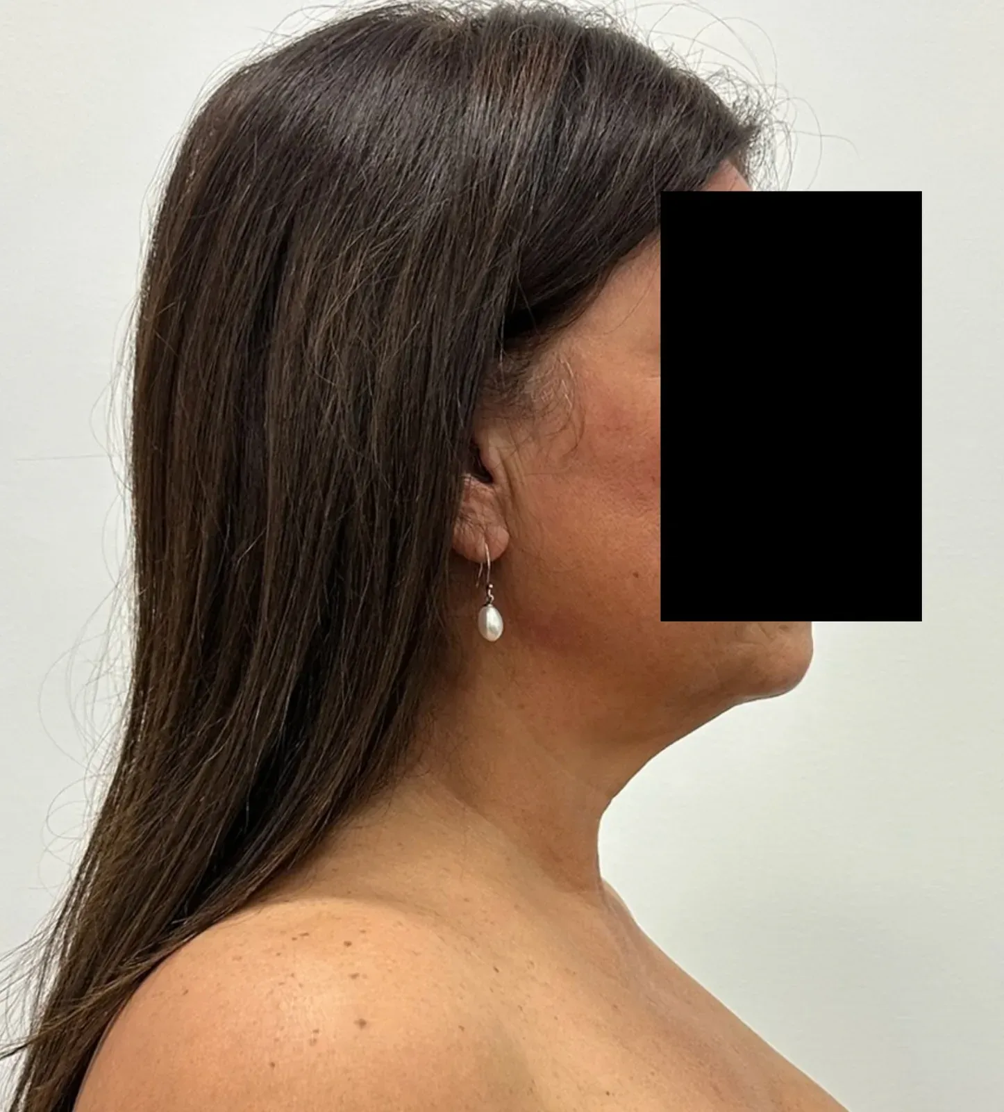 Before chin and neck liposuction and Renuvion, side view, case 1015