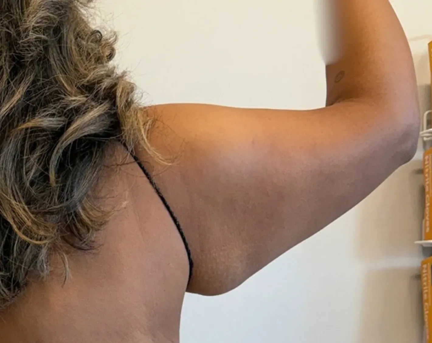 Before liposuction and Renuvion, back view 2, case 1019