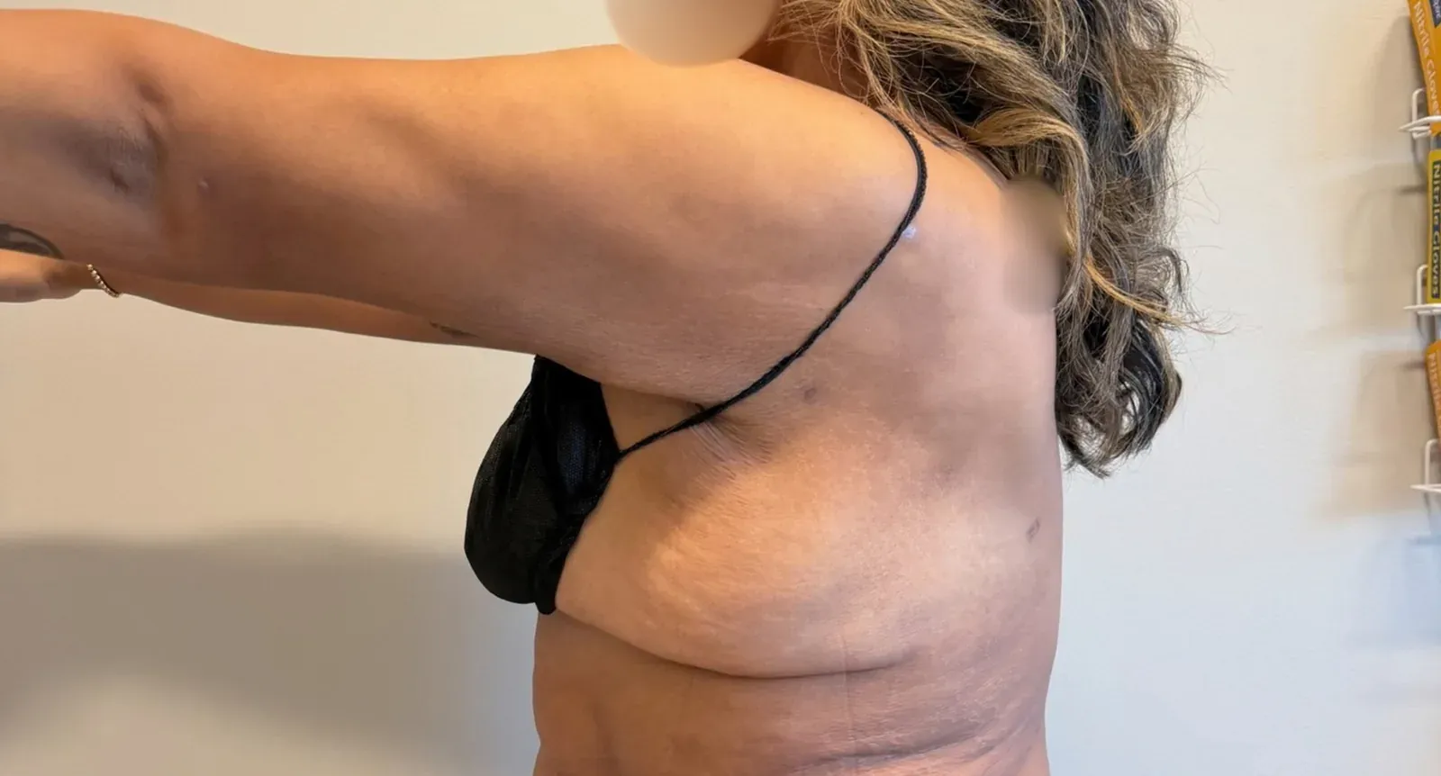 After liposuction and Renuvion, back view, case 1019