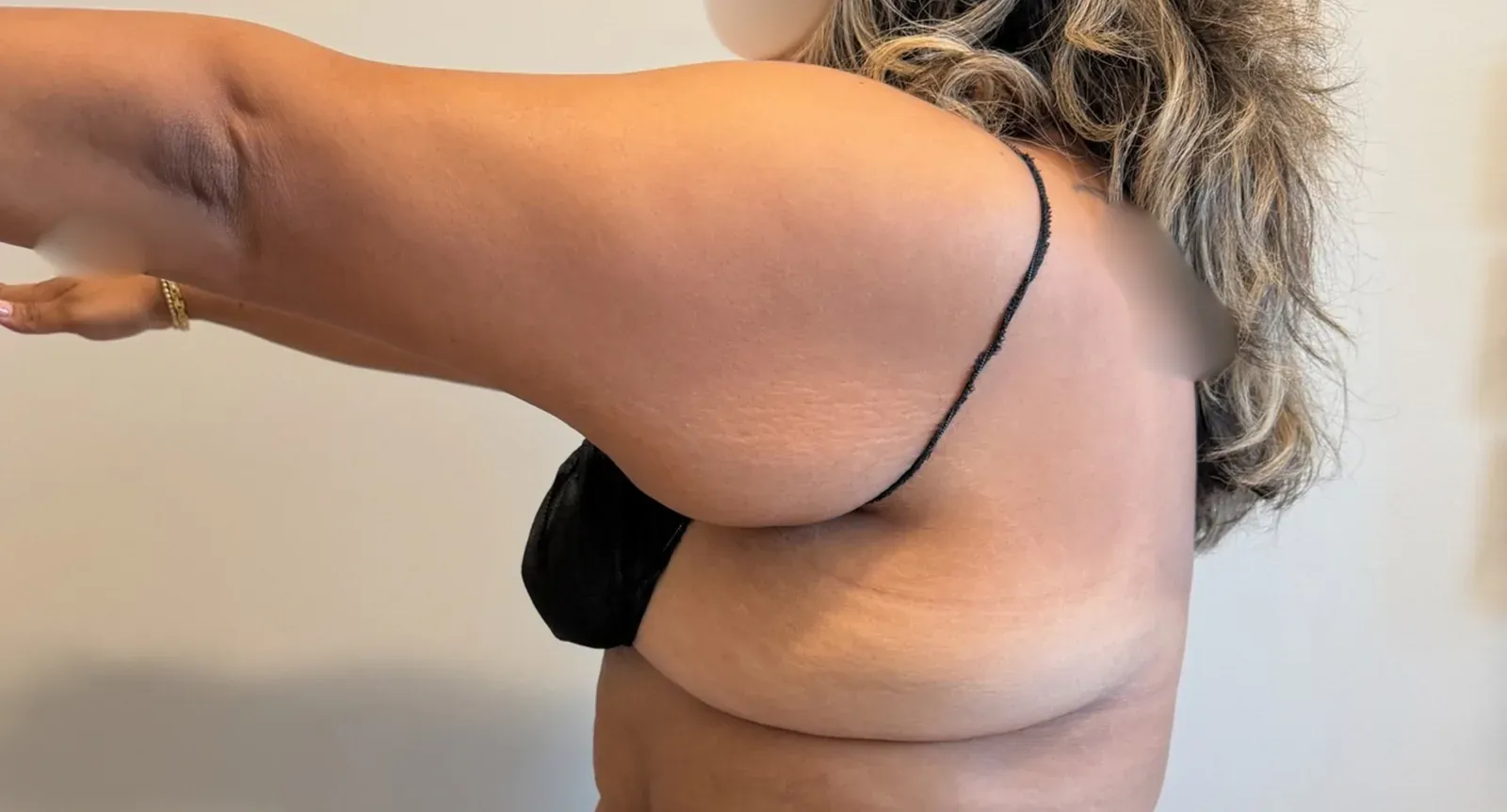 Before liposuction and Renuvion, back view, case 1019