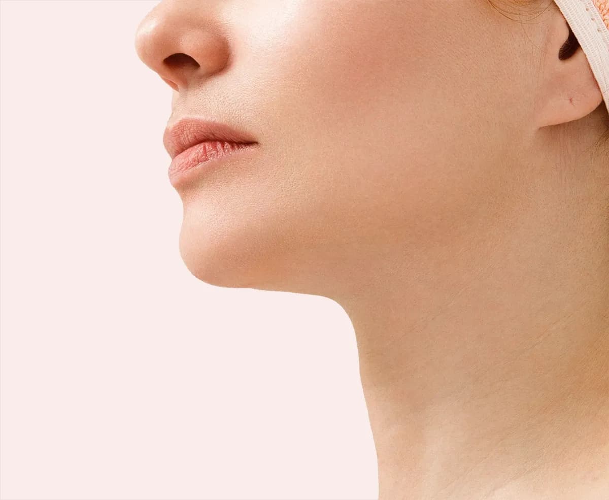 Chin liposuction, after