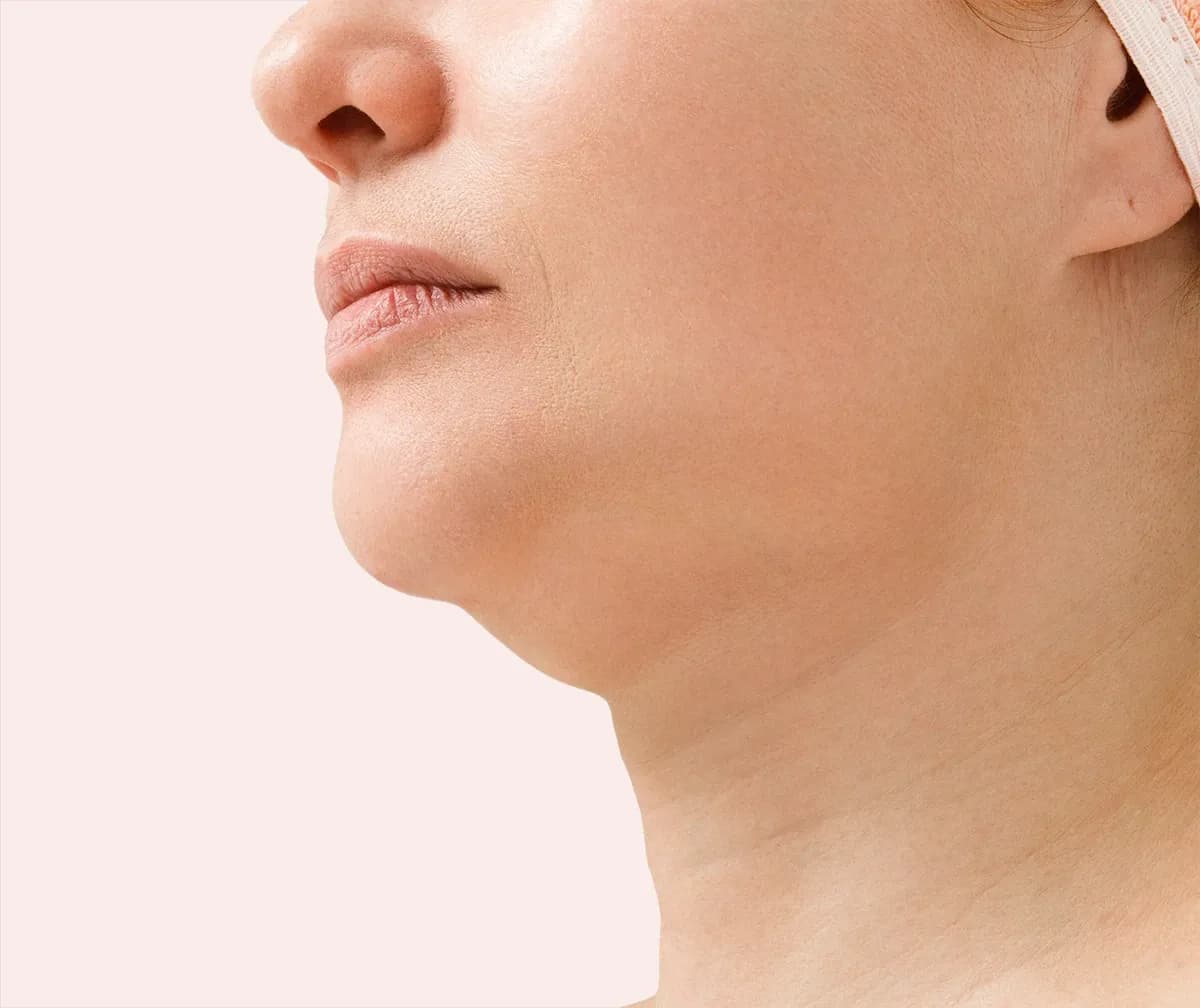 Chin liposuction, before