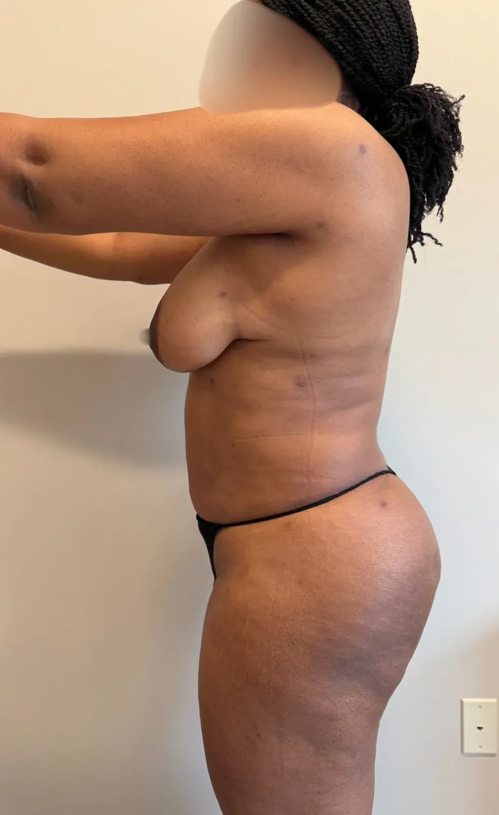 After liposuction and Renuvion, side view, case 1003