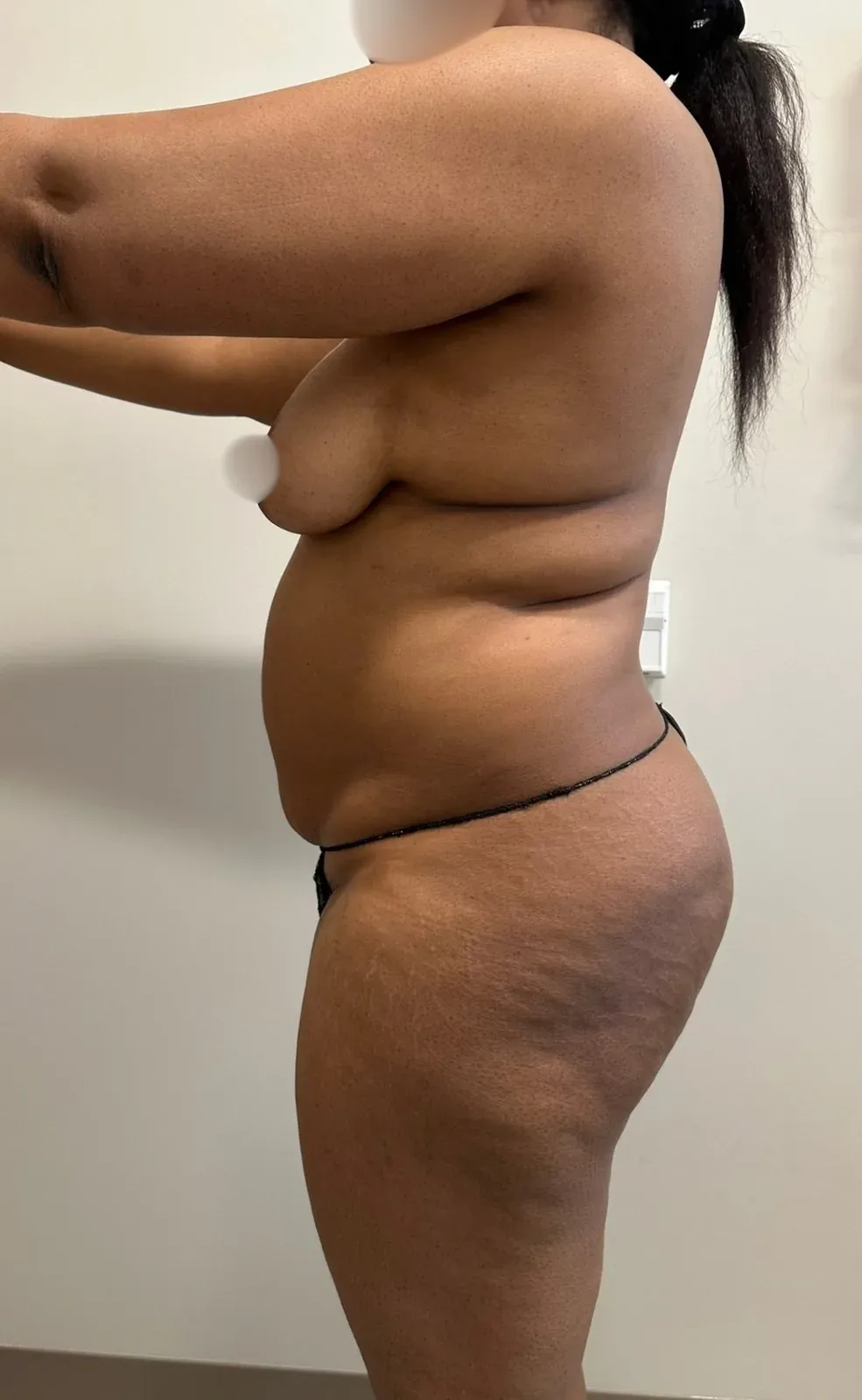 Before liposuction and Renuvion, side view, case 1003