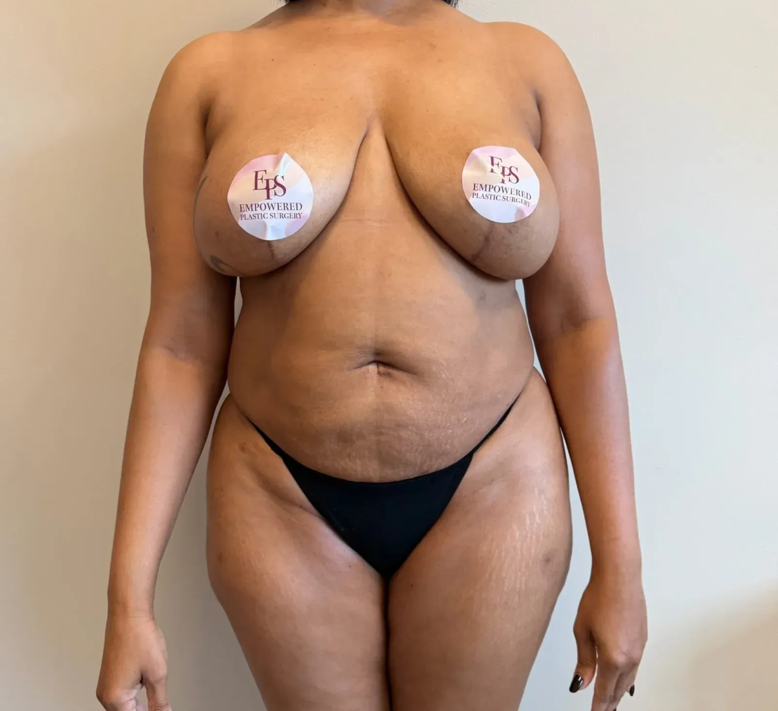 After liposuction and Renuvion, front view, case 1006