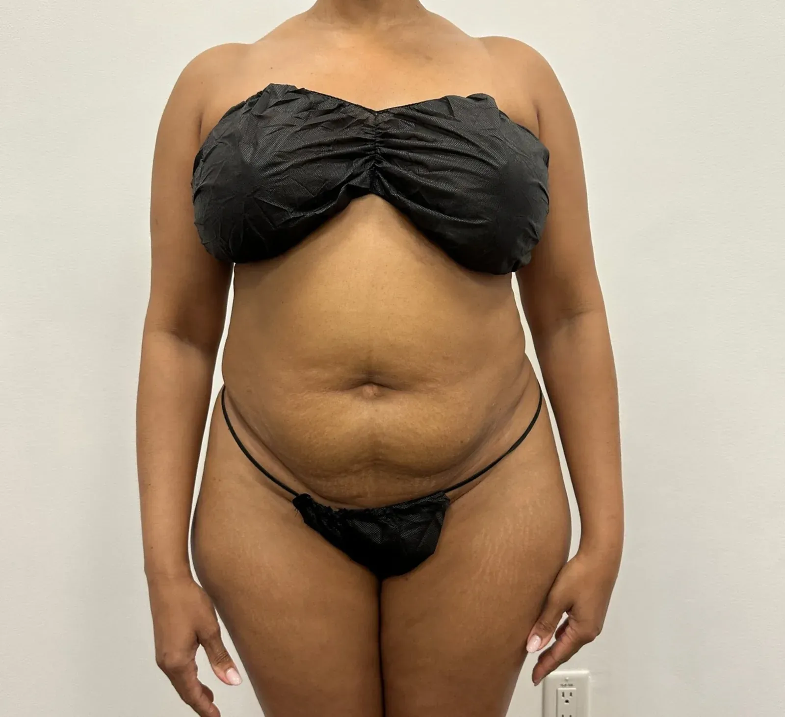 Before liposuction and Renuvion, front view, case 1006