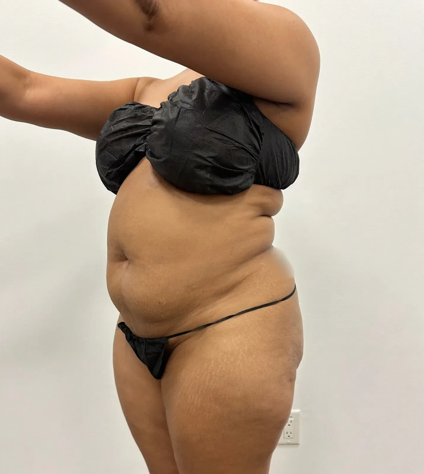 Before liposuction and Renuvion, oblique view, case 1006