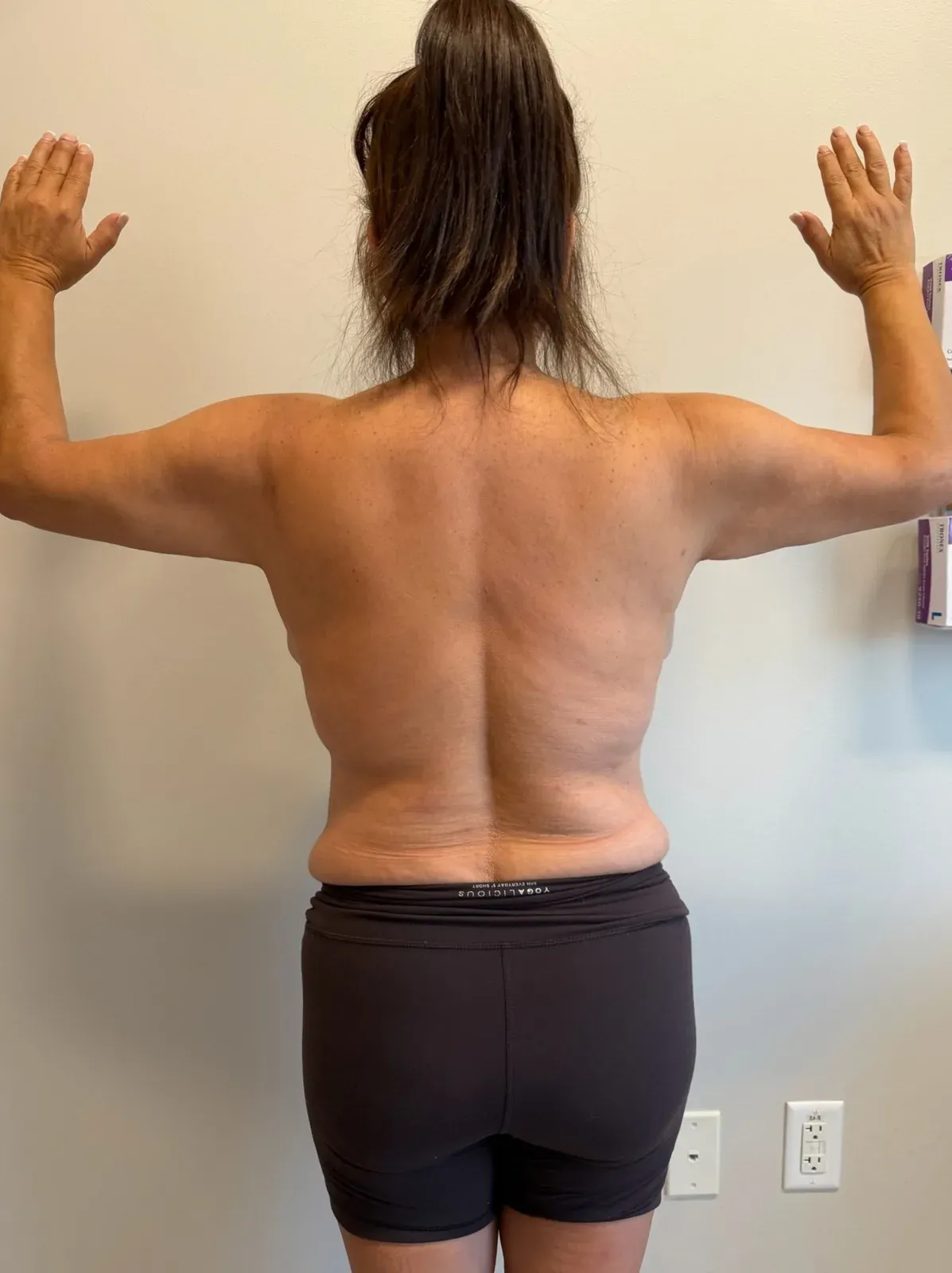 After liposuction and Renuvion, back view, case 1009